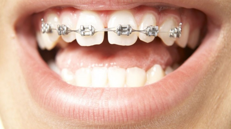 Răng thưa có hại như thế nào? Phải làm cách nào để hết răng thưa?